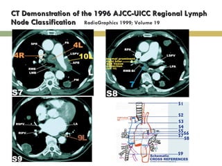 CT Demonstration of the 1996 AJCC-UICC Regional Lymph Node Classification  RadioGraphics 1999; Volume 19 