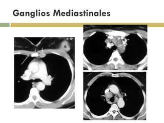 Ganglios Mediastinales 