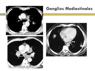 Ganglios Mediastinales 
