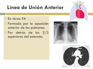 Línea de Unión Anterior Rx tórax PA Formada por la aposición anterior de los pulmones. Por detrás de los 2/3 superiores del esternón. 