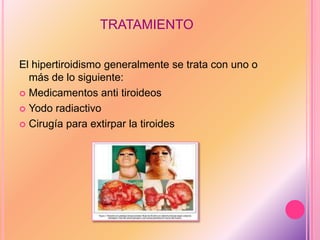 TRATAMIENTO
El hipertiroidismo generalmente se trata con uno o
más de lo siguiente:
 Medicamentos anti tiroideos
 Yodo radiactivo
 Cirugía para extirpar la tiroides
 