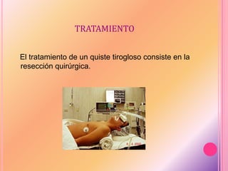 TRATAMIENTO
El tratamiento de un quiste tirogloso consiste en la
resección quirúrgica.
 