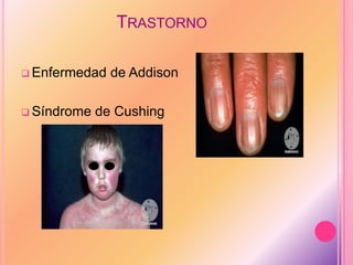 TRASTORNO
 Enfermedad de Addison
 Síndrome de Cushing
 