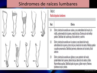 Síndromes de raíces lumbares
 