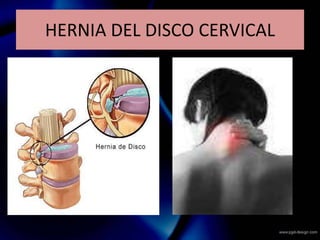 HERNIA DEL DISCO CERVICAL
 