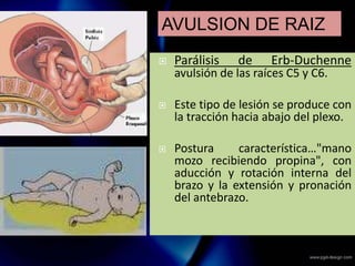 Parálisis de Erb-Duchenne
avulsión de las raíces C5 y C6.
 Este tipo de lesión se produce con
la tracción hacia abajo del plexo.
 Postura característica…"mano
mozo recibiendo propina", con
aducción y rotación interna del
brazo y la extensión y pronación
del antebrazo.
AVULSION DE RAIZ
 