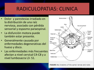 RADICULOPATIAS: CLINICA
• Dolor y parestesias irradiado en
la distribución de una raíz
nerviosa, asociado con pérdida
sensorial y espasmo paraespinal.
• La disfunción motora puede
también estar presente.
• Generalmente causada por
enfermedades degenerativas del
hueso y disco.
• Las enfermedades más frecuentes
afectan a nivel cervical C4-C8 y a
nivel lumbosacra L3- S1.
 