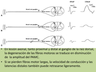 • En lesión axonal, tanto proximal y distal al ganglio de la raíz dorsal,
la degeneración de las fibras motoras se traduce en disminución
de la amplitud del PAMC.
• Si se pierden fibras motor largas, la velocidad de conducción y las
latencias distales también puede retrasarse ligeramente.
 