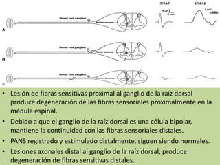 • Lesión de fibras sensitivas proximal al ganglio de la raíz dorsal
produce degeneración de las fibras sensoriales proximalmente en la
médula espinal.
• Debido a que el ganglio de la raíz dorsal es una célula bipolar,
mantiene la continuidad con las fibras sensoriales distales.
• PANS registrado y estimulado distalmente, siguen siendo normales.
• Lesiones axonales distal al ganglio de la raíz dorsal, produce
degeneración de fibras sensitivas distales.
 