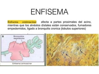 anatomia-patologica-de-pulmon-pdf