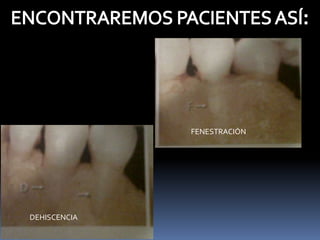 DEHISCENCIA
FENESTRACIÓN
 