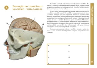 ANATOMIA
NA
PRÁTICA
25
O encéfalo é formado pelo cérebro, cerebelo e tronco encefálico. As-
sim que a calvária e a dura-máter são removidas, ficam visíveis os giros
(pregas), sulcos e fissuras do córtex cerebral. O cérebro inclui os hemis-
férios cerebrais e os núcleos da base.
A dura-máter (paquimeninge) é a meninge mais externa, envolve
o encéfalo e a medula espinal. No encéfalo é composta pelo extrato ósseo
e o extrato meníngeo que, ao se separarem, formam as foices e os seios
durais. O traumatismo craniano pode provocar hemorragia epidural, e o
sangue da artéria meníngea média acumula-se entre a lâmina periosteal
externa da dura e a calvária (hematoma epi ou extradural). A hemorra-
gia subaracnoidea é o extravasamento sanguíneo no espaço subaracnoi-
deo (ESA) e resulta, na maioria das vezes, de ruptura de aneurisma da
artéria carótida interna. Este tipo de hemorragia pode gerar sintomas
como rigidez nucal, cefaleia e perda de consciência.
Os ossos do neurocrânio evolvem o encéfalo e formam a calota cra-
niana e a base do crânio: frontal, parietal, temporal, occipital, esfenoide
e etmoide.
Exposição do telencéfalo
no crânio - vista lateral
4.
a)
b)
c)
d)
e)
f)
g)
h)
4. EXPOSIÇÃO DO TELENCÉFALO NO CRÂNIO
VISTA LATERAL
c
e
b
h
f
g
a
d
 