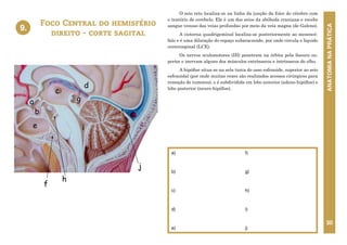 ANATOMIA
NA
PRÁTICA
30
O seio reto localiza-se na linha da junção da foice do cérebro com
o tentório do cerebelo. Ele é um dos seios da abóboda craniana e recebe
sangue venoso das veias profundas por meio da veia magna (de Galeno).
A cisterna quadrigeminal localiza-se posteriormente ao mesencé-
falo e é uma dilatação do espaço subaracnoide, por onde circula o líquido
cerecrospinal (LCE).
Os nervos oculomotores (III) penetram na órbita pela fissura su-
perior e inervam alguns dos músculos extrínsecos e intrínsecos do olho.
A hipófise situa-se na sela turca do osso esfenoide, superior ao seio
esfenoidal (por onde muitas vezes são realizados acessos cirúrgicos para
remoção de tumores), e é subdividida em lobo anterior (adeno-hipófise) e
lobo posterior (neuro-hipófise).
Foco Central do hemisfério
direito - corte sagital
9.
a)
b)
c)
d)
e)
f)
g)
h)
i)
j)
9. FOCO CENTRAL DO HEMISFÉRIO DIREITO
CORTE SAGITAL
h
i
f
b
e
a
c
d
g
j
 