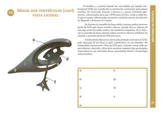 ANATOMIA
NA
PRÁTICA
31
O encéfalo e a medula espinal são circundados por líquido cere-
brospinal (LCE) que é produzido no interior dos ventrículos, pelos plexos
coroides. Os ventrículos laterais, o terceiro e o quarto ventrículo apre-
sentam comunicações para que o LCE possa circular, sendo a saída des-
te para o espaço subaracnoideo no quarto ventrículo através dos forames
de Magendi e do forame de Luscka.
As fraturas de assoalho da fossa média craniana podem provocar
perda de LCE pelo meato acústico externo, quando houver ruptura de
meninge acima da orelha média e da membrana timpânica. Já as fratu-
ras no assoalho da fossa anterior podem envolver a lâmina cribiforme do
etmoide e provocar perda de LCE pelo nariz.
A hidrocefalia obstrutiva ocorre pela produção excessiva de LCE,
pela obstrução de seu fluxo ou pela interferência na sua absorção. Na
hidrocefalia comunicante o fluxo do LCE para o sistema venoso pode ser
parcialmente obstruído, talvez pela ausência congênita das granulações
aracnoideas ou por obstrução destas granulações devido à hemorragia
subaracnoidea.
Molde dos ventrículos (cast)
vista lateral
10.
a)
b)
c)
d)
e)
f)
g)
h)
i)
e
f
a
h
g
10. MOLDE DOS VENTRÍCULOS (CAST)
VISTA LATERAL
b
c
d
i
 