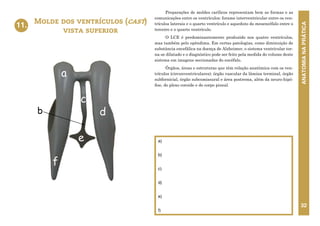 ANATOMIA
NA
PRÁTICA
32
Preparações de moldes carílicos representam bem as formas e as
comunicações entre os ventrículos: forame interventricular entre os ven-
trículos laterais e o quarto ventrículo e aqueduto do mesencéfalo entre o
terceiro e o quarto ventrículo.
O LCE é predominantemente produzido nos quatro ventrículos,
mas também pelo epêndima. Em certas patologias, como diminuição de
substância encefálica na doença de Alzheimer, o sistema ventricular tor-
na-se dilatado e o diagnóstico pode ser feito pela medida do volume deste
sistema em imagens seccionadas do encéfalo.
Órgãos, áreas e estruturas que têm relação anatômica com os ven-
trículos (circunventriculares): órgão vascular da lâmina terminal, órgão
subfornicial, órgão subcomissural e área postrema, além da neuro-hipó-
fise, do plexo coroide e do corpo pineal.
Molde dos ventrículos (cast)
vista superior
11.
a)
b)
c)
d)
e)
f)
c
d
f
a
11. MOLDE DOS VENTRÍCULOS (CAST)
VISTA SUPERIOR
e
b
 