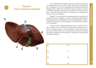 ANATOMIA
NA
PRÁTICA
70
7. FÍGADO – VISTA POSTERO-INFERIOR
c
a
f
b
g
e
d
h
A face diafragmática do fígado é coberta por peritônio visceral, ex-
ceto posteriormente, na área nua do fígado, onde está em contato direto
com o diafragma. A área nua é demarcada pela reflexão do peritônio do
diafragma para o fígado como as lâminas anterior, superior e posterior
do ligamento coronário. Essas lâminas encontram-se à direita para for-
mar o ligamento triangular direito e divergem para a esquerda para
envolver a área nua triangular.
O fígado é o local primário de desintoxicação das substâncias ab-
sorvidas pelo sistema digestório, e assim é vulnerável à lesão celular e
consequente fibrose, acompanhadas de nódulos degenerativos. Há des-
truição dos hepatócitos na cirrose hepática e sua substituição por gordu-
ra e tecido fibroso.
Embora muitos solventes industriais, como o tetracloreto de car-
bono, causem cirrose, o distúrbio é mais frequente em pessoas que so-
frem de alcoolismo crônico. A cirrose alcoólica, a mais comum de mui-
tas causas de hipertensão porta, é caracterizada por aumento do fígado.
Este órgão tem grande reserva funcional, o que protela o surgimento de
insuficiência hepática.
Fígado –
Vista postero inferior
a)
b)
c)
d)
e)
f)
g)
h)
7.
 