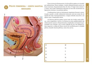ANATOMIA
NA
PRÁTICA
75
Pelve feminina - corte sagital
mediano
a)
b)
c)
d)
e)
f)
g)
h)
i)
j)
k)
l)
2.
Casos severos de dismenorreia e de dor pélvica podem ser causados
por endometriose. Nesta condição, o tecido endometrial pode ocorrer em
locais anormais, frequentemente fora do útero. O lugar mais comum é
o ovário, mas tecido endometrial aberrante já tem sido encontrado nos
ligamentos uterinos e no peritônio pélvico.
A endometriose torna-se clinicamente importante durante a mens-
truação, quando o tecido endometrial aberrante não tem meios de ser
expulso do corpo. Consequentemente, o sangue coletado causa dor e, em
alguns casos, complicações sérias.
As fraturas pélvicas podem causar lesão dos tecidos moles pélvi-
cos, vasos sanguíneos e nervos. As fraturas na área pubobturadora são
relativamente comuns e frequentemente complicadas em função da pro-
ximidade com a bexiga e com a uretra. Quedas de pé ou de nádegas po-
dem empurrar a cabeça do fêmur através do acetábulo para a cavidade
pélvica, lesando vísceras pélvicas, vasos e/ou nervos.
2. PELVE FEMININA - CORTE SAGITAL
MEDIANO
a
h
e
b
g
c
f
i
k
d
j
l
 
