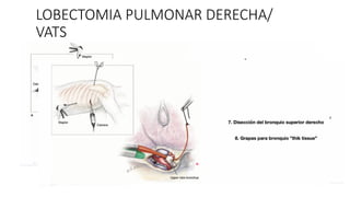 LOBECTOMIA PULMONAR DERECHA/
VATS
 