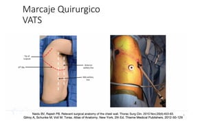 Marcaje Quirurgico
VATS
 