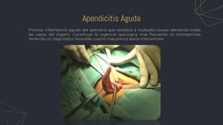 1. Proceso inflamatorio agudo del apéndice que obedece a múltiples causas afectando todas
las capas del órgano. Constituye la urgencia quirúrgica mas frecuente en emergencias
teniendo un diagnostico favorable cuanto mas precoz sea la intervención.
Apendicitis Aguda
 