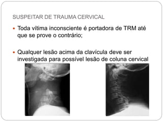 SUSPEITAR DE TRAUMA CERVICAL 
Toda vítima inconsciente é portadora de TRM até que se prove o contrário; 
Qualquer lesão acima da clavícula deve ser investigada para possível lesão de coluna cervical  