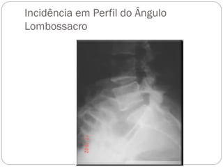 Incidência em Perfil do Ângulo Lombossacro  