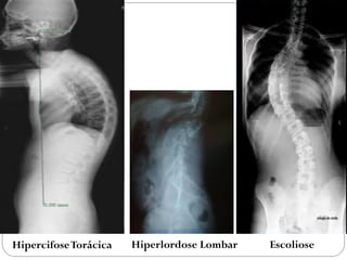 Hipercifose Torácica 
Hiperlordose Lombar 
Escoliose  