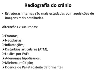 Radiografia do crânio
• Estruturas internas são mais estudadas com aquisições de
  imagens mais detalhadas.

Alterações visualizadas:

Fraturas;
Neoplasias;
Inflamações;
Distúrbios articulares (ATM);
Lesões por PAF;
Adenomas hipofisários;
Mieloma múltiplo;
Doença de Paget (osteíte deformante).
 