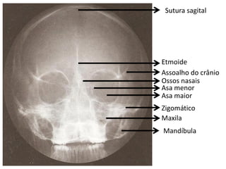 Sutura sagital




Etmoide
Assoalho do crânio
Ossos nasais
Asa menor
Asa maior
Zigomático
Maxila
Mandíbula
 