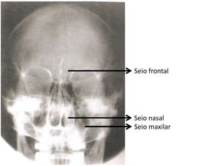 Seio frontal




Seio nasal
Seio maxilar
 