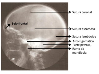 Sutura coronal


Seio frontal
               Sutura escamosa

               Sutura lambdoide
               Arco zigomático
               Parte petrosa
               Ramo da
               mandíbula
 