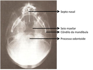 Septo nasal




Seio maxilar
Côndilo da mandíbula

Processo odontoide
 