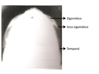 Zigomático

Arco zigomático




Temporal
 
