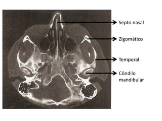 Septo nasal


Zigomático


Temporal

Côndilo
mandibular
 