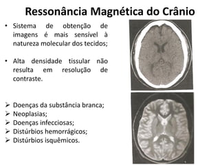 Ressonância Magnética do Crânio
• Sistema de obtenção de
  imagens é mais sensível à
  natureza molecular dos tecidos;

• Alta densidade tissular não
  resulta em resolução de
  contraste.


   Doenças da substância branca;
   Neoplasias;
   Doenças infecciosas;
   Distúrbios hemorrágicos;
   Distúrbios isquêmicos.
 