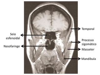 Temporal
    Seio
 esfenoidal
              Processo
              zigomático
Nasofaringe
              Masseter

              Mandíbula
 