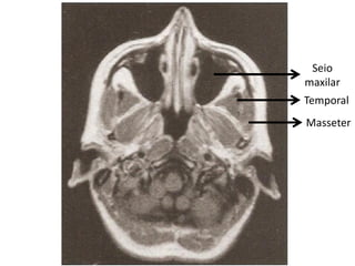 Seio
maxilar
Temporal
Masseter
 