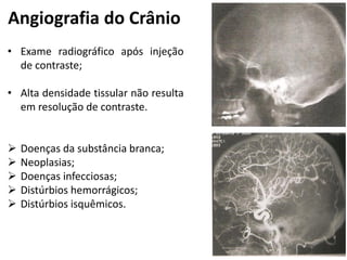 Angiografia do Crânio
• Exame radiográfico após injeção
  de contraste;

• Alta densidade tissular não resulta
  em resolução de contraste.


   Doenças da substância branca;
   Neoplasias;
   Doenças infecciosas;
   Distúrbios hemorrágicos;
   Distúrbios isquêmicos.
 