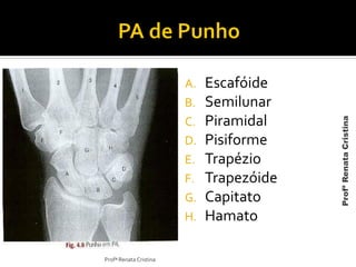 A. Escafóide
B. Semilunar
C. Piramidal
D. Pisiforme
E. Trapézio
F. Trapezóide
G. Capitato
H. Hamato
Profª Renata Cristina
ProfªRenataCristina
 