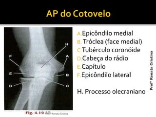 A.Epicôndilo medial
B. Tróclea (face medial)
C.Tubérculo coronóide
D.Cabeça do rádio
E.Capítulo
F.Epicôndilo lateral
H. Processo olecraniano
Profª Renata Cristina
ProfªRenataCristina
 