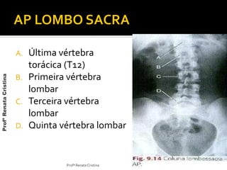 A. Última vértebra
torácica (T12)
B. Primeira vértebra
lombar
C. Terceira vértebra
lombar
D. Quinta vértebra lombar
Profª Renata Cristina
ProfªRenataCristina
 
