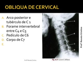 A. Arco posterior e
tubérculo de C 1
B. Forame intervertebral
entre C4 e C5
C. Pedículo de C6
D. Corpo de C7
E.
Profª Renata Cristina
ProfªRenataCristina
 