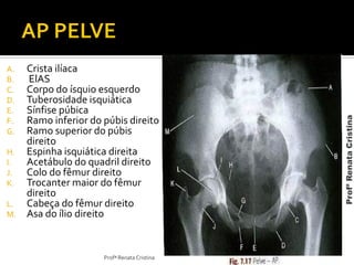 A. Crista ilíaca
B. ElAS
C. Corpo do ísquio esquerdo
D. Tuberosidade isquiática
E. Sínfise púbica
F. Ramo inferior do púbis direito
G. Ramo superior do púbis
direito
H. Espinha isquiática direita
I. Acetábulo do quadril direito
J. Colo do fêmur direito
K. Trocanter maior do fêmur
direito
L. Cabeça do fêmur direito
M. Asa do ílio direito
Profª Renata Cristina
ProfªRenataCristina
 