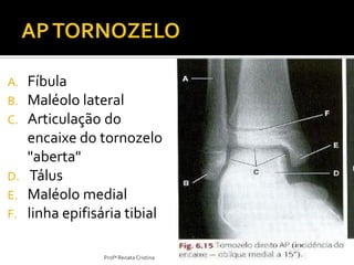 A. Fíbula
B. Maléolo lateral
C. Articulação do
encaixe do tornozelo
"aberta"
D. Tálus
E. Maléolo medial
F. linha epifisária tibial
Profª Renata Cristina
 
