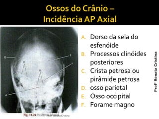 A. Dorso da sela do
esfenóide
B. Processos clinóides
posteriores
C. Crista petrosa ou
pirâmide petrosa
D. osso parietal
E. Osso occipital
F. Forame magno
Profª Renata Cristina
ProfªRenataCristina
 