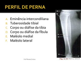 A. Eminência intercondiliana
B. Tuberosidade tibial
C. Corpo ou diáfise da tíbia
D. Corpo ou diáfise da fíbula
E. Maléolo medial
F. Maléolo lateral
Profª Renata Cristina
 