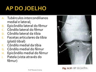 A. Tubérculos intercondilianos
medial e lateral;
B. Epicôndilo lateral do fêmur
C. Côndilo lateral do fêmur
D. Côndilo lateral da tíbia
E. Facetas articulares da tíbia
(platô tibial)
F. Côndilo medial da tíbia
G. Côndilo medial do fêmur
H. Epicôndilo medial do fêmur
I. Patela (vista através do
fêmur)
Profª Renata Cristina
 