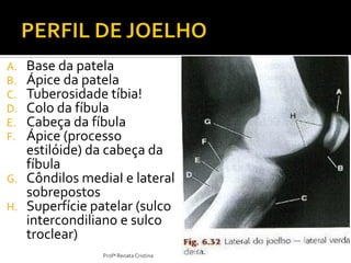 A. Base da patela
B. Ápice da patela
C. Tuberosidade tíbia!
D. Colo da fíbula
E. Cabeça da fíbula
F. Ápice (processo
estilóide) da cabeça da
fíbula
G. Côndilos mediaI e lateral
sobrepostos
H. Superfície patelar (sulco
intercondiliano e sulco
troclear)
Profª Renata Cristina
 