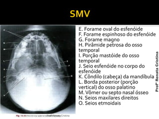 E. Forame oval do esfenóide
F. Forame espinhoso do esfenóide
G. Forame magno
H. Pirâmide petrosa do osso
temporal
I. Porção mastóide do osso
temporal
J. Seio esfenóide no corpo do
esfenóide
K. Côndilo (cabeça) da mandíbula
L. Borda posterior (porção
vertical) do osso palatino
M.Vômer ou septo nasal ósseo
N. Seios maxilares direitos
O. Seios etmoidais
Profª Renata Cristina
ProfªRenataCristina
 