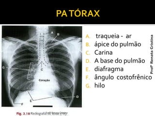 A. traqueia - ar
B. ápice do pulmão
C. Carina
D. A base do pulmão
E. diafragma
F. ângulo costofrênico
G. hilo
Profª Renata Cristina
ProfªRenataCristina
 